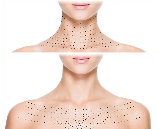Mærkning på huden på halsen og decolletéen for foryngende biorevitalisering