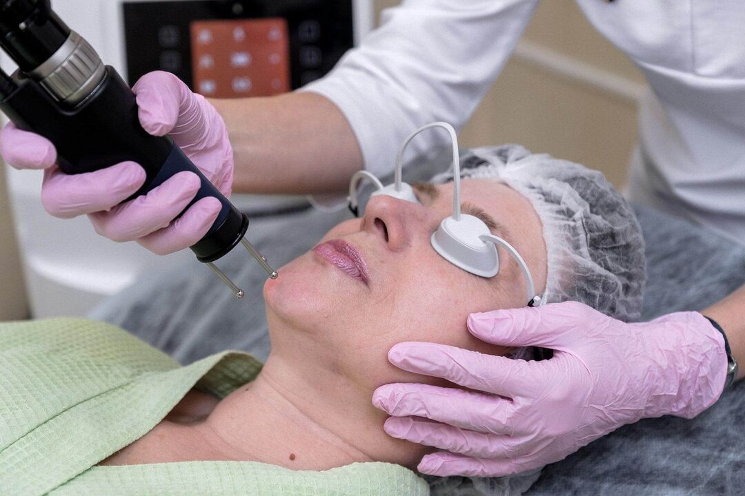 Ablativ laser hudforyngelse procedure