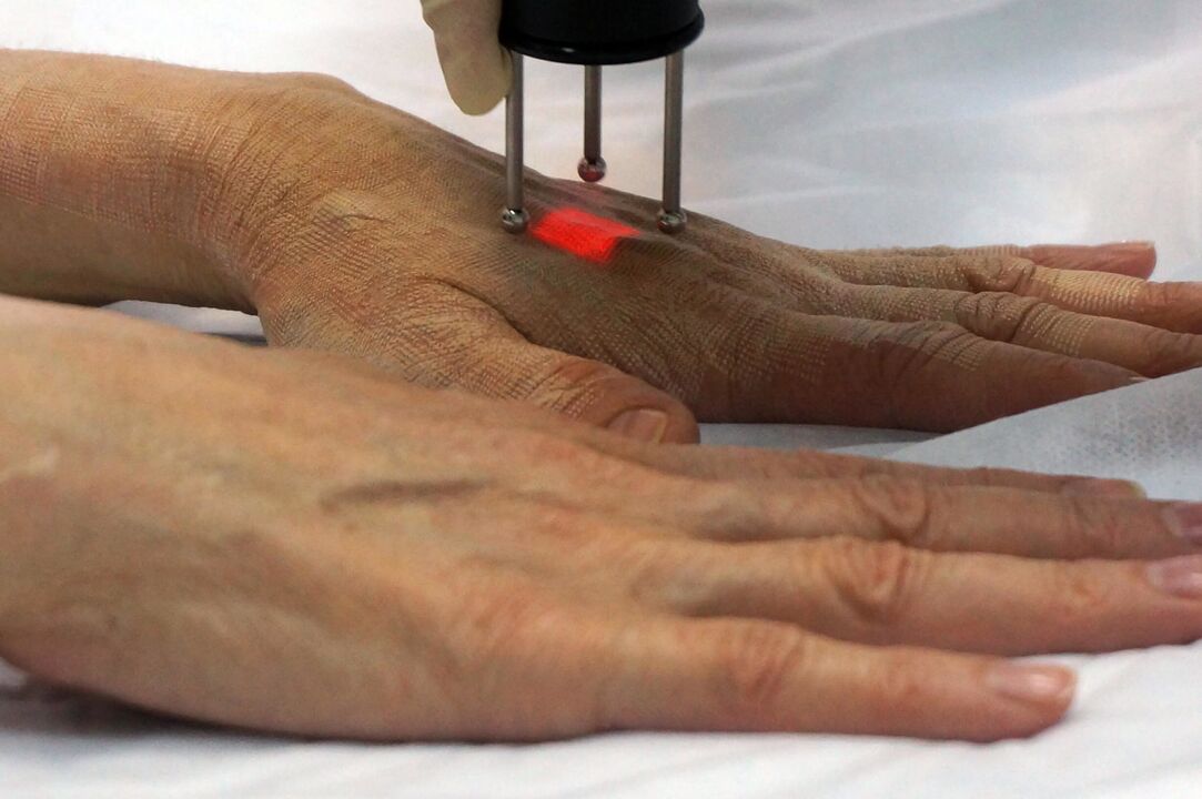 Laserforyngelse af hænderne med en ikke-ablativ metode