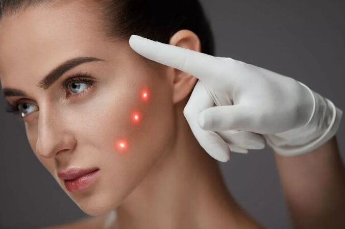 Laserforyngelse af huden