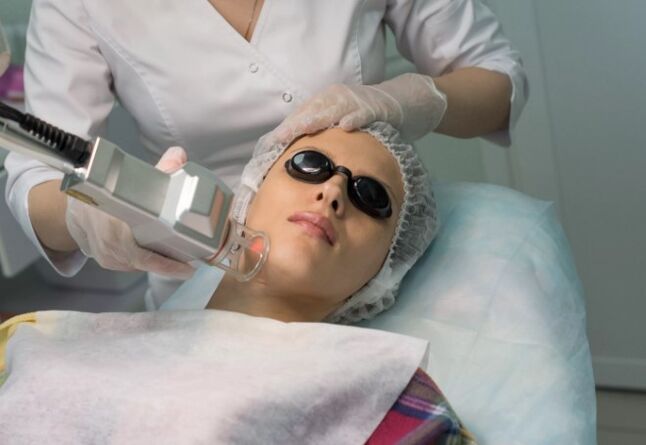 Feltforyngelse med en laser