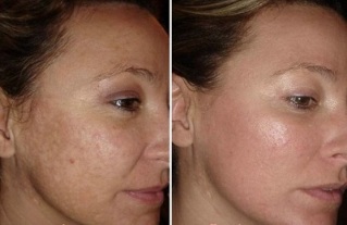 laser ansigtshudforyngelse før og efter fotos